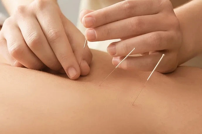 طب سوزنی و تاثیر آن بر سیاتیک