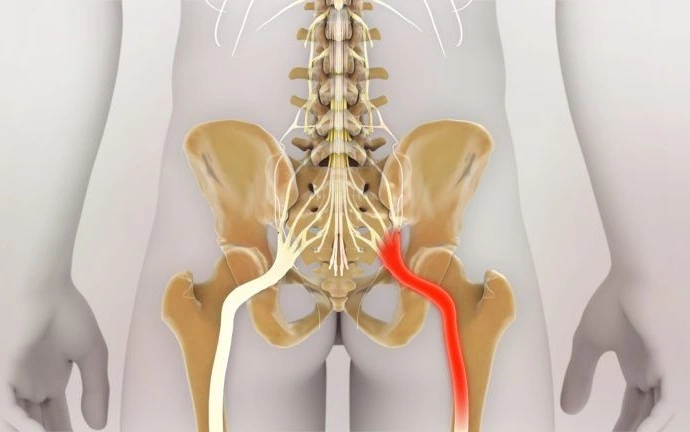 حرکات اصلاحی سیاتیک