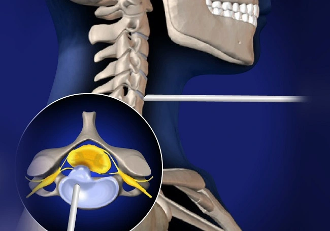 آندوسکوپی دیسک گردن