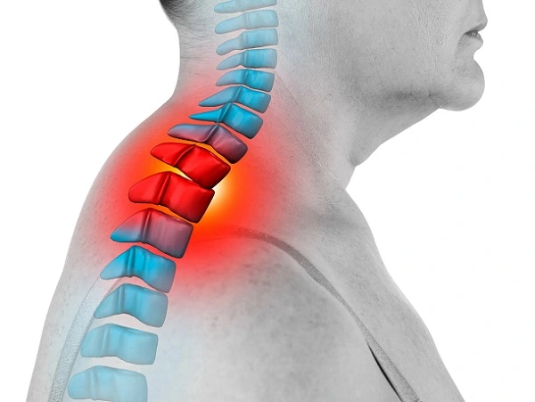 حرکات اصلاحی قوز گردن