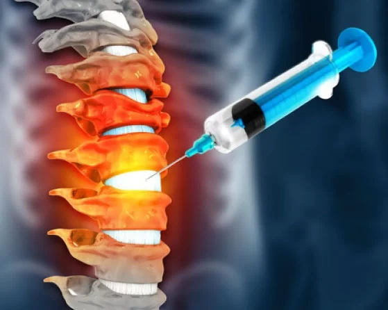 تزریق اپیدورال درد کمر