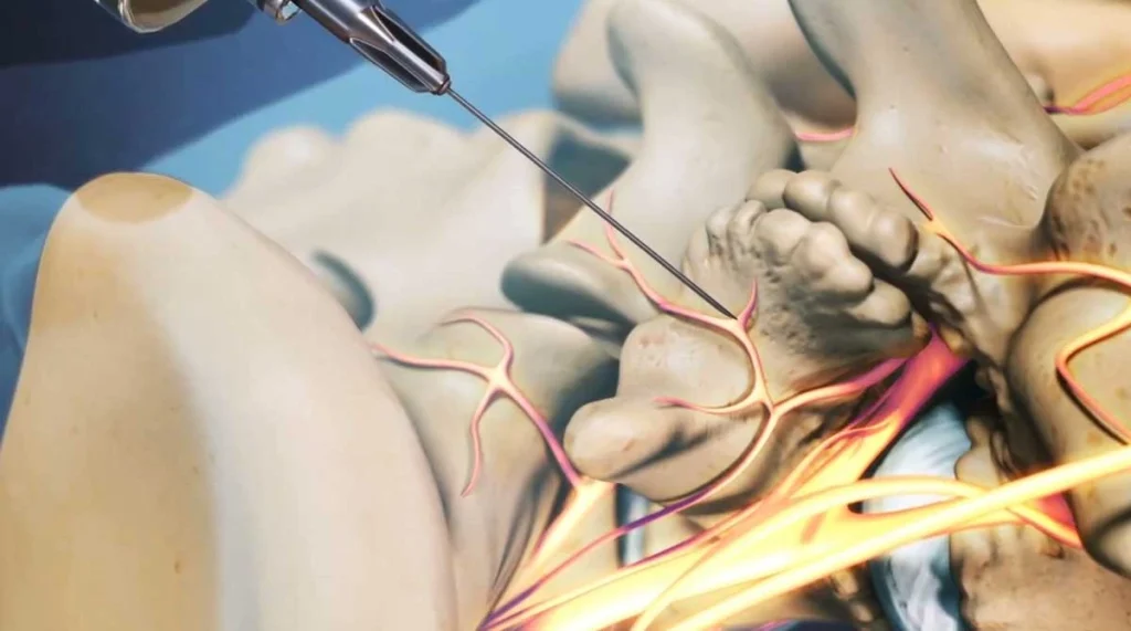 بلوک عصبی دیسک کمر