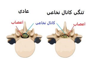علل ایجاد تنگی کانال نخاعی کمر