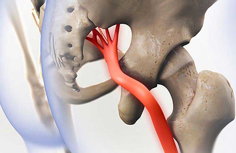 درمان عصب سیاتیک پای چپ