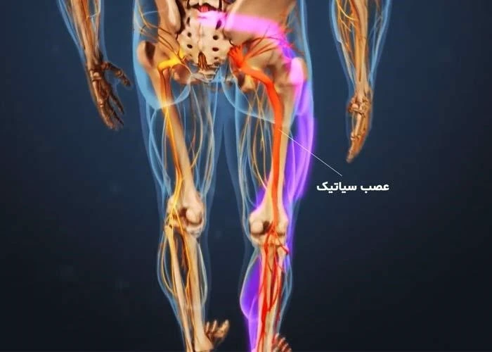درمان زود عصب سیاتیک پای راست