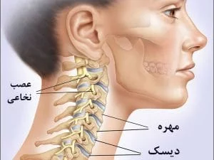 تشخیص دیسک گردن
