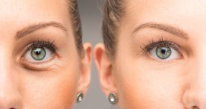 ماندگاری پی آر پی زیر چشم