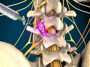عصبهای هدف در بلوک عصبی میگرن