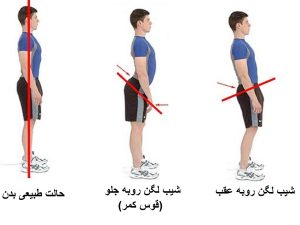 شناخت گودی کمر و علل ایجاد آن