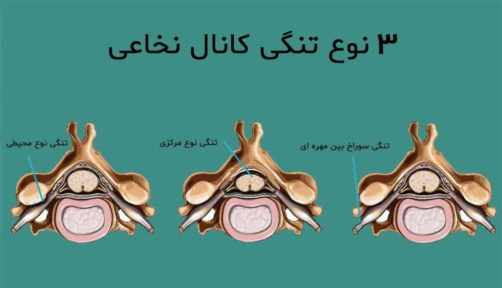 درمان تنگی کانال نخاعی کمر