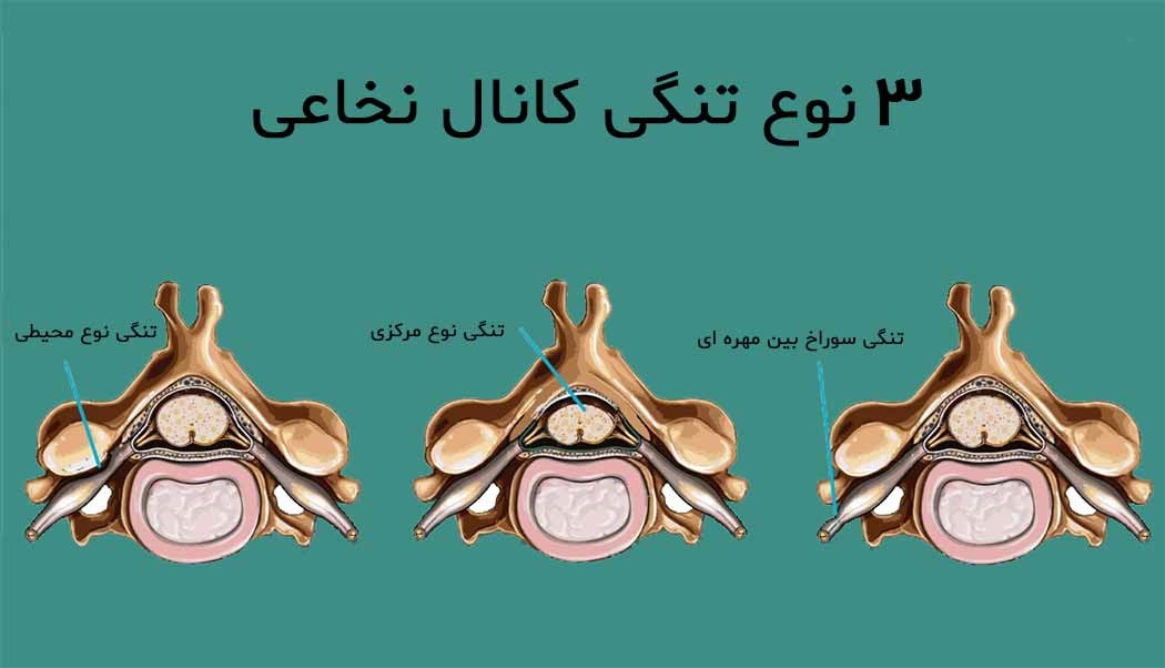 درمان تنگی کانال نخاعی کمر