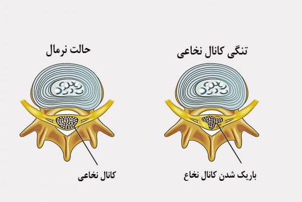 علائم تنگی کانال نخاعی در زنان