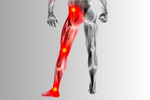 علائم عصب سیاتیک پای چپ