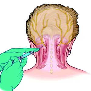 روش انجام بلوک عصبی برای سردرد