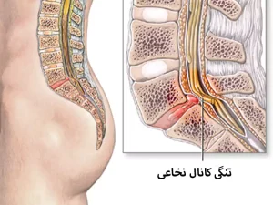 تشخیص تنگی کانال نخاعی در سالمندان