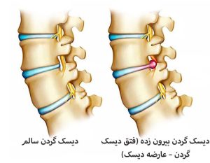 درمان دیسک گردن بدون جراحی